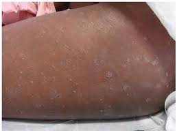 His eczema was initially managed in. Jcm Free Full Text Diagnosis Of Atopic Dermatitis Mimics Overlaps And Complications Html