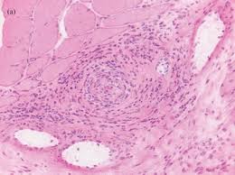Image result for Microscopic Polyangiitis
