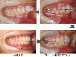 May 27, 2021 · 敵「出っ歯ひどいから矯正だけしても多分そこまで良くならんけどやるか？ 117: çŸ¯æ­£æ²»ç™‚ åŒ»ç™‚æ³•äººç¤¾å›£think æˆ'å­«å­å¥åº·æ­¯ç§'