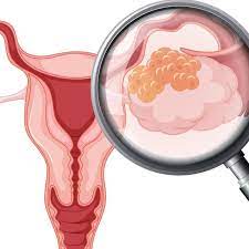 See full list on dietdietsihat.com Gejala Awal Kanker Serviks Sesuai Stadium 1 4 Apa Saja