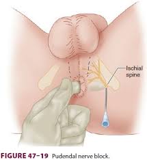 Image result for Pudendal Block