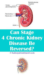 Kidney Stones Diet Kidney Disease Symptoms Polycystic Kidney Disease Kidney Disease