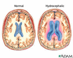 Image result for Hydrocephalus