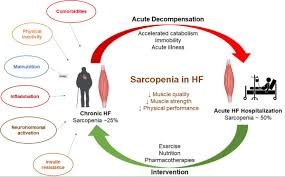 Maybe you would like to learn more about one of these? Jags On Twitter The Other Striated Muscle The Role Of Sarcopenia In Older Persons With Heart Failure Geriatrics Heartfailure Https T Co Fdth57shyx Https T Co Zmi0h6djl8