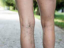 Maybe you would like to learn more about one of these? Varicose Spider Veins Causes Symptoms And Treatments