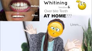 In some cases, overbites can be corrected by giving teeth enough space to move in. How I Whitened My Sensitive And Overbite Teeth At Home Youtube