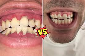 Image result for Gingivitis