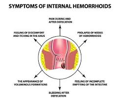 Image result for Hemorrhoid