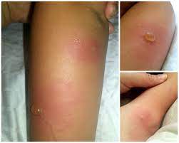 Allergic Reaction To Mosquito Bite Images Peepsburgh