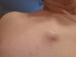 Risks associated with the placement and use of central lines. How Does A Port Work For Chemo Lungcancer Net