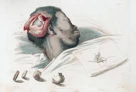 Image result for Skull Trephination