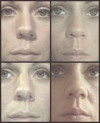Before And After Deviated Septum Surgery Septoplasty Reconstruction Septum Septum Ring Nose Ring