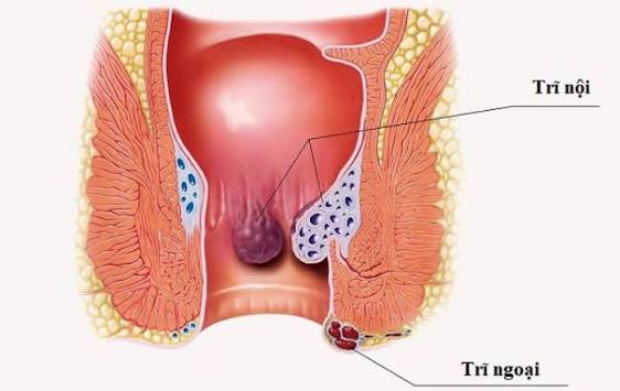 Bác sĩ khám và điều trị bệnh trĩ ở TP Hồ Chí Minh
