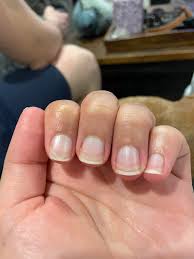 Image result for Muehrcke Line