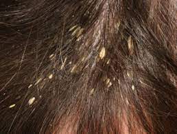 It does not result in scarring or alopecia. Pityriasis Amiantacea Dermnet Nz
