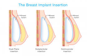 Breast Implant In Iran Affordable Breast Implant Cost