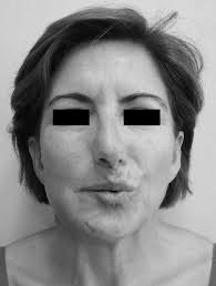 Cirugía Oral y Maxilofacial