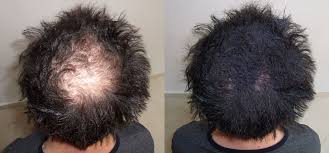 Apply to the ends of the hair and work your. Regrow Hair Can You Grow Back Lost Hair Twins Hair Loss