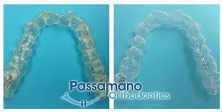 How to deep clean invisalign retainers. How To Clean A Crusty Invisalign Tray Or Retainer At Home Invisalign Diy Retainer Cleaner How To Clean Invisalign