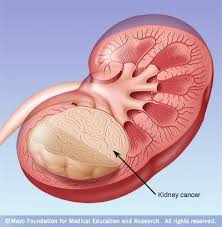 Pin On Cancer Care
