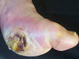 Check spelling or type a new query. Diabetic Foot Ulcer Dermnet Nz