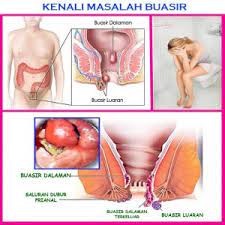 Ini antara tips saya kecutkan sendiri buasir ketika mengandung dengan mengambil set buasir shaklee dan hilang dalam masa 1 malam sahaja. Buasir Semasa Mengandung Kenali Punca Dan Rawatan Terbaik