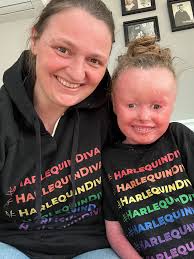 Image result for Ichthyosis