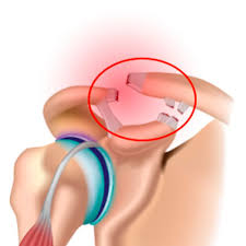 Image result for AC Dislocation