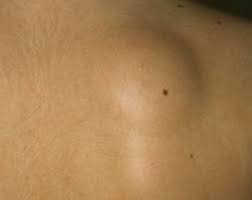 I have a lump on my back on the shoulder blade. Lump Under Skin On Shoulder Blade On Dog