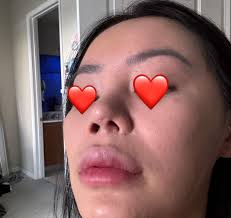 Hello everyone, did you experience hollow eyes or "sunken" eyes after  rhino? I'm 3 weeks post op, I'm aware I'm still very swollen, just curious  for your experience. Thank you ❤️