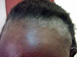 If you're going through scalp issues and you're trying to figure out what's going on, this video is for you. Know The Signs 6 Scalp Problems We May Have To Deal With At Some Point In Our Life Scalp Problems Sebhorric Dermatitis Scalp Seborrheic Dermatitis Scalp