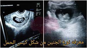 معرفه نوع الجنين من شكل كيس الحمل في السونار youtube