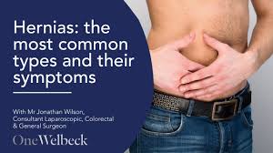 Image result for stomach hernia symptoms