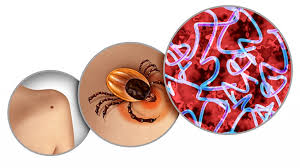 Image result for Lyme Carditis