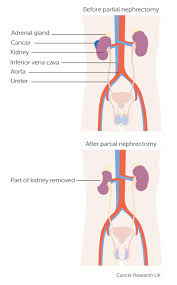 Kidney Cancer Symptoms Diagnosis Treatment Urology