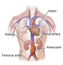The aorta is the largest blood vessel in the body. Abdominal Aortic Aneurysm Wikipedia