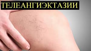 как избавиться от звездочек на ногах в домашних условиях Pin Na Doske Domashnie Sekrety Krasoty