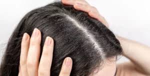 Image result for lice vs dandruff