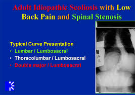 Managing Scoliosis Stenosis With Low Lumbar Degeneration