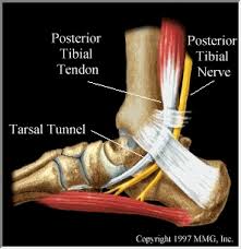Tarsal Tunnel Syndrome Pain Prevent