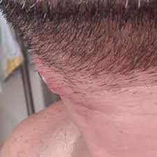 Many people who have thick or curly hair get a type of ingrown hair called pseudofolliculitis. Ingrown Hair Went Bad Under Strict Instructions From The Dr Not To Squeeze It Popping