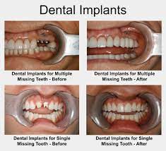 What Are The Benefits Of Dental Sealants Dental Implants Tooth Implant Cost Dental