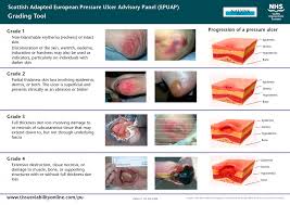 Image Result For Pressure Sore Grading Pressure Ulcer