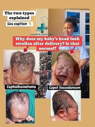 Image result for Cephalhematoma