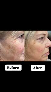 🪄Monday Makeover🪄 @sciton_tennessee BBL Fotofacial after one session. ,  ✨March special is buy a BBL package (3 sessions) and receive a free  @skinmedica Even &Correct treatment cream $178 value 🫢., ., ...