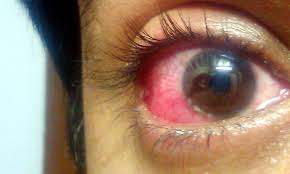 Image result for Ciliary Flush