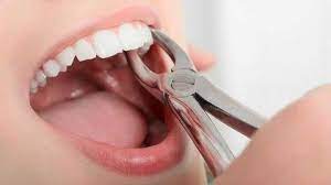 Dental Extraction Basic Principles Forceps Elevators Dental Extraction Wisdom Tooth Extraction Tooth Extraction