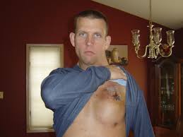 2011-03-26 Swolen Chest - Everest Strong | Rob Besecker