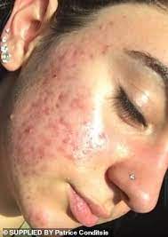 I can't stand the peach fuzz on my face, especially because i have very dark hair. Student Who Developed Cystic Acne After Laser Hair Removal Reveals How She Healed Her Scars Daily Mail Online