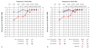 Audiometry Screening And Interpretation American Family